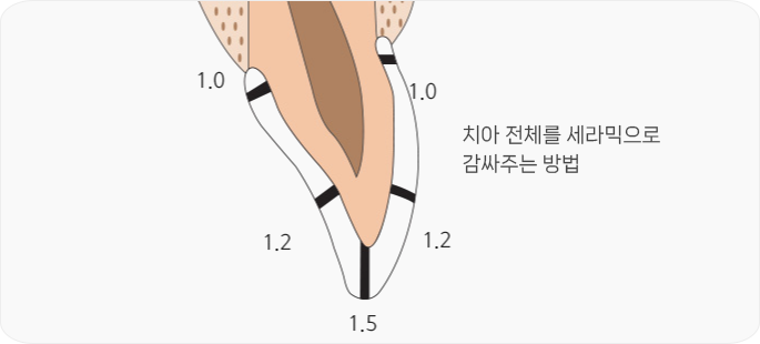 올세라믹